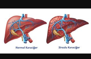 Karaciğerin Sinsi Tehlikesi: Siroz